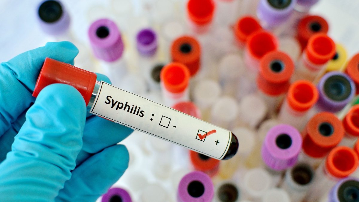 Σημαντική αύξηση της τάξης του 65% στα καταγεγραμμένα περιστατικά σύφιλης στην Ελλάδα, την περίοδο 2020–2022, καταγράφει πρόσφατη